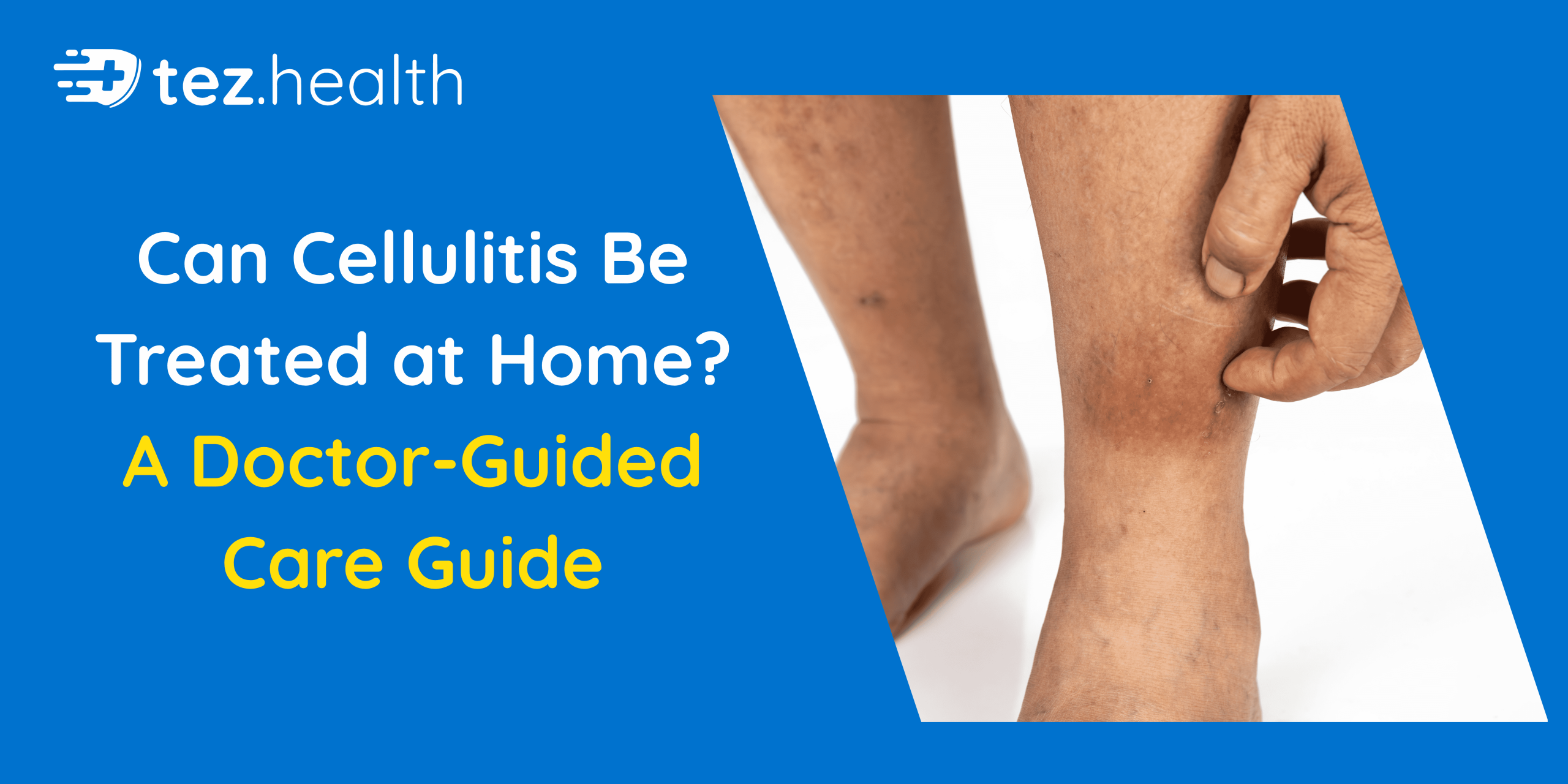 Can Cellulitis Be Treated at Home? A Doctor-Guided Care Guide