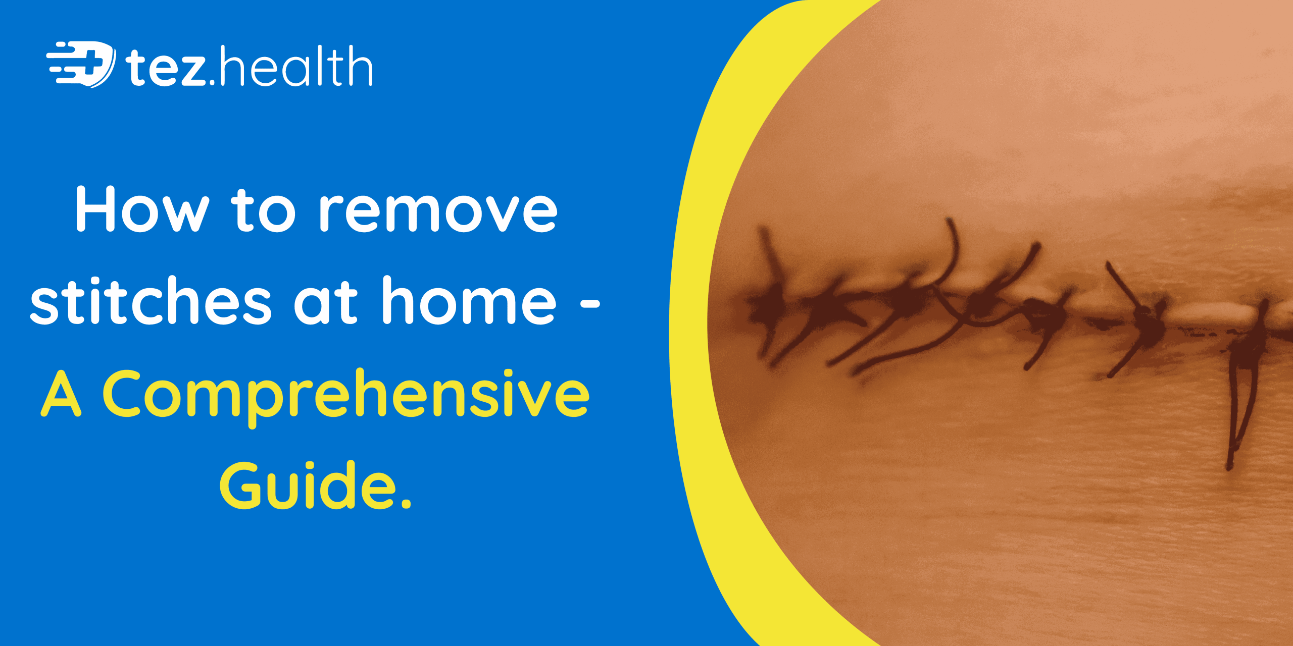 How to Remove Stitches at Home – A Comprehensive Guide