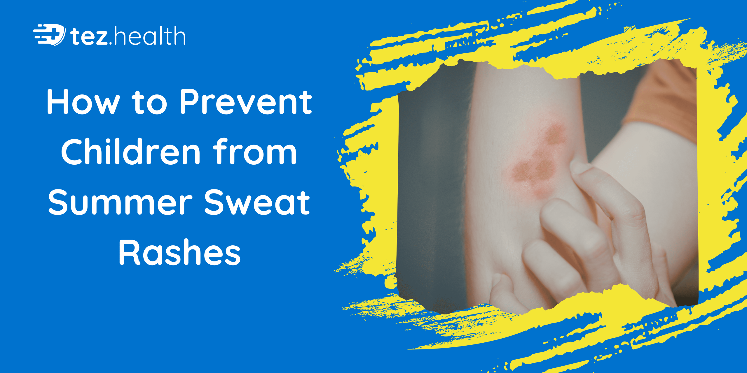 How to Prevent Children from Summer Sweat Rashes