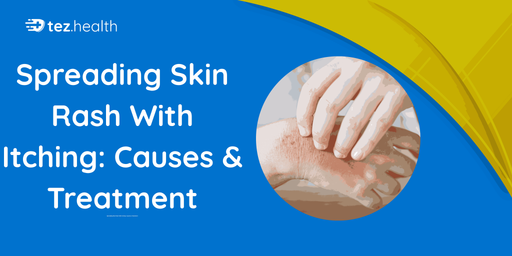 Spreading Skin Rash With Itching: Causes & Treatment