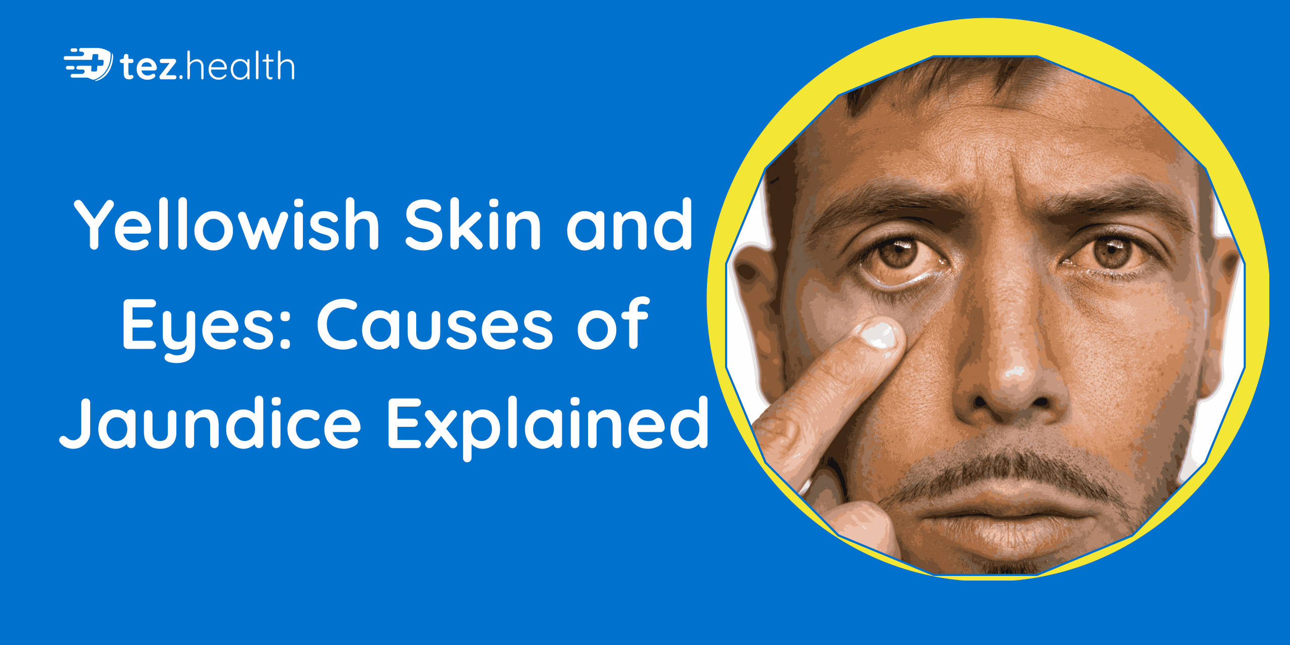 Yellowish Skin and Eyes: Causes of Jaundice Explained