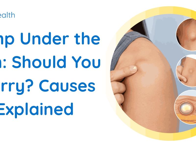 Lump Under the Skin: Should You Worry? Causes Explained