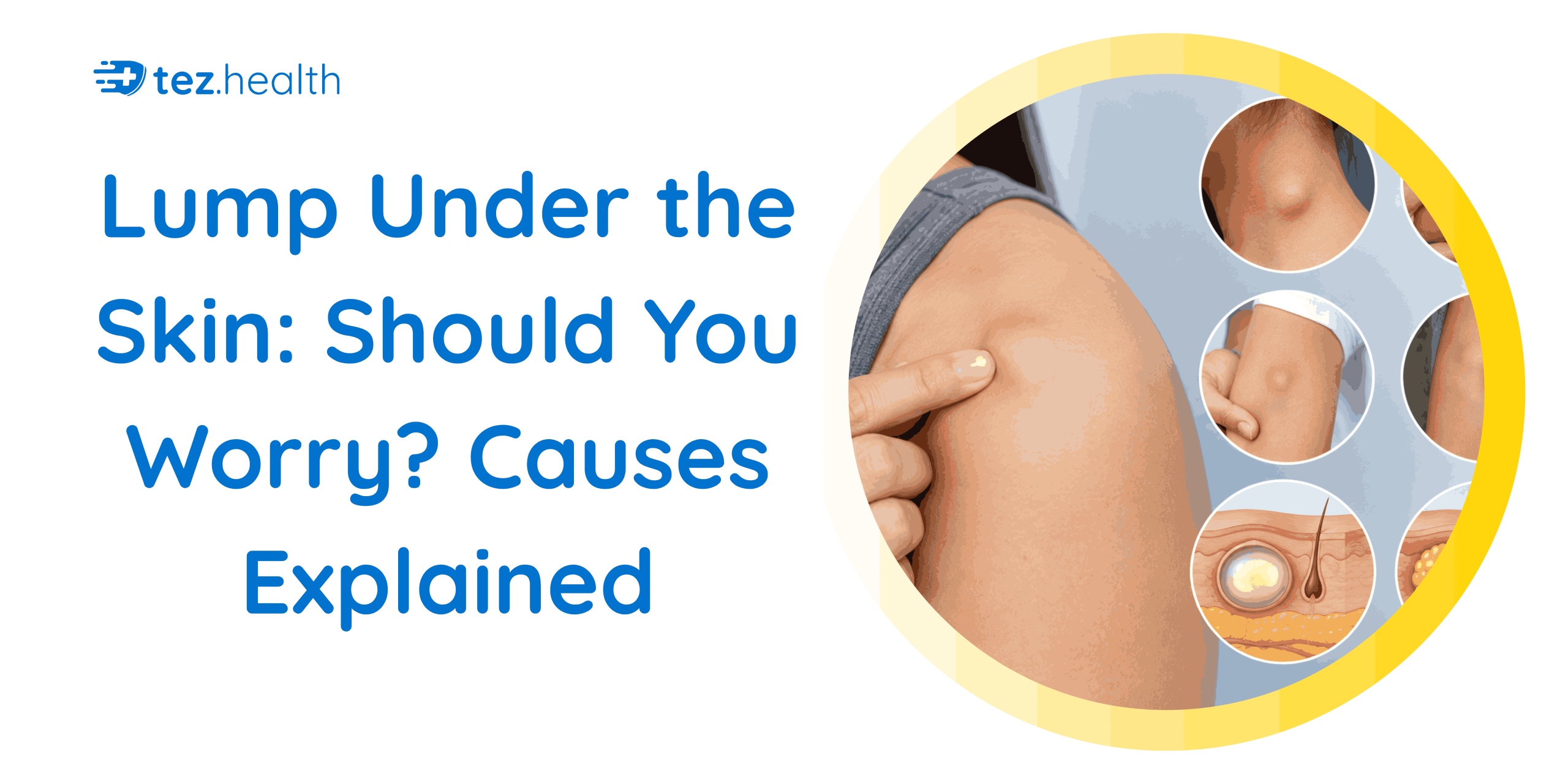 Lump Under the Skin: Should You Worry? Causes Explained